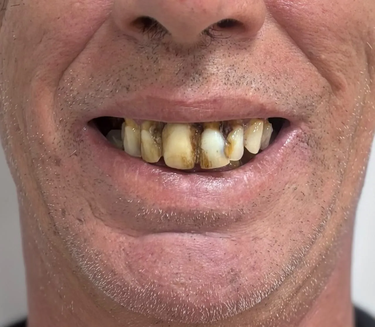 Reabilitação oral — antes