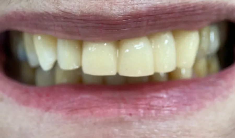 Prótese fixa anterior — provisório