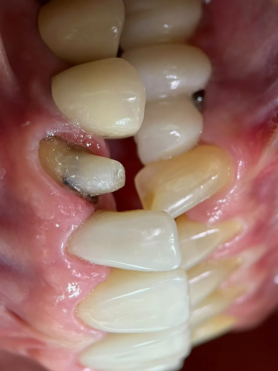 Coroa sobre dente — antes