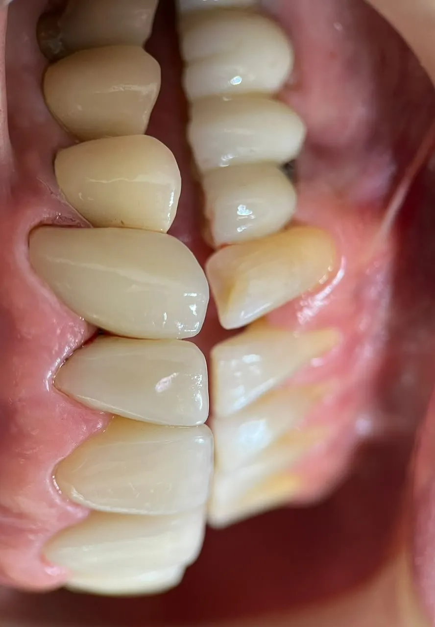 Coroa sobre dente — depois