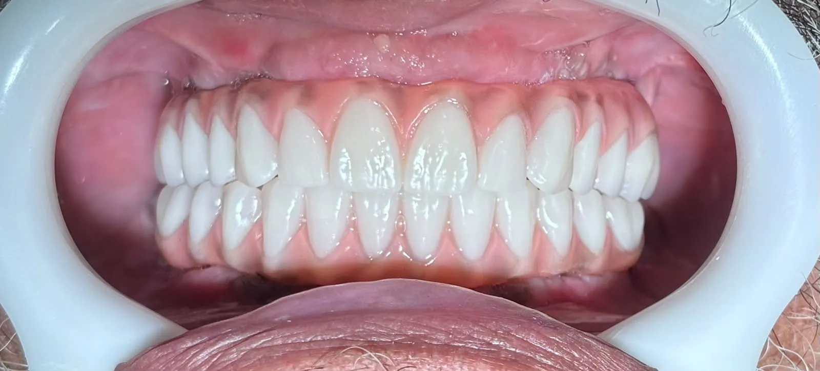 Prótese protocolo sobre implantes — prótese instalada